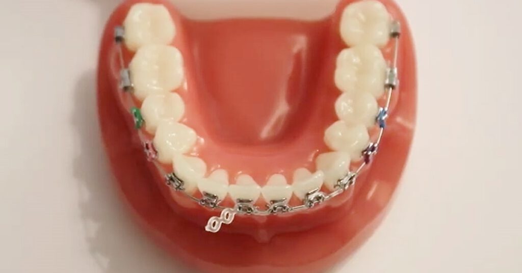 orthodontic repairs at home during covid19