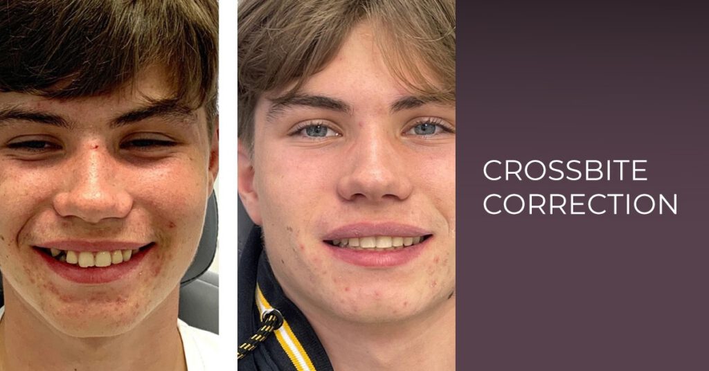 crossbite treatment leamington spa dental