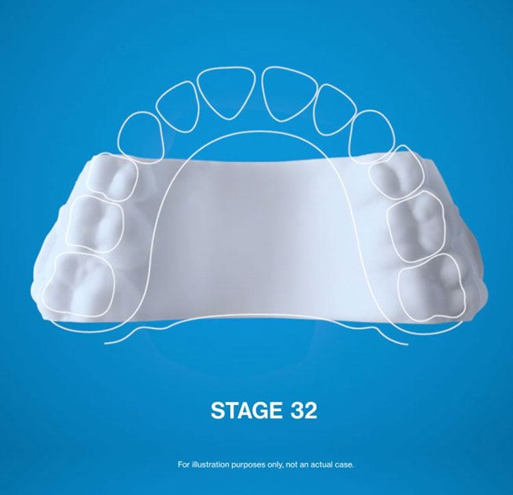 stage 32 of invisalign process